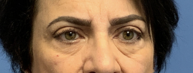 Upper-Blepharoplasty--Case-Study-859 | After Blepharoplasty